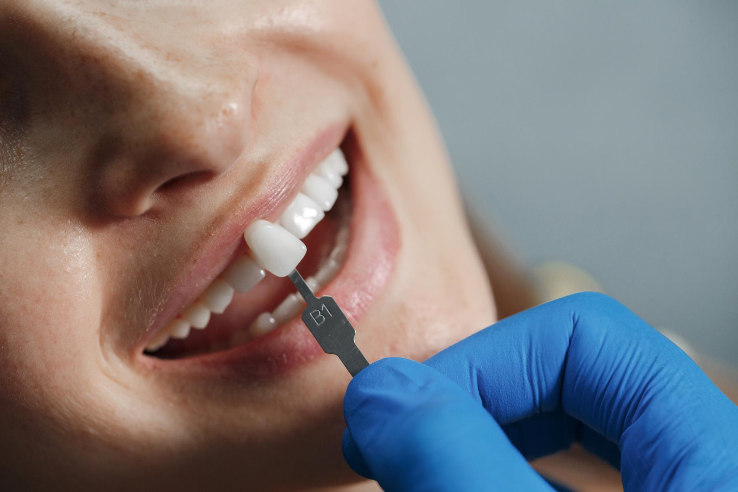 dentista-blanqueando-dientes